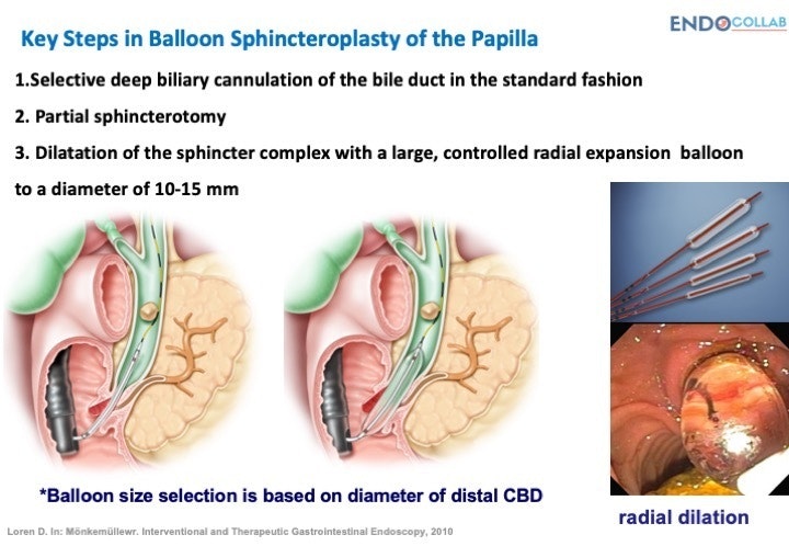 Balloon Sphincteroplasty - Key Steps 13 Balloon Sphincteroplasty – Key Steps