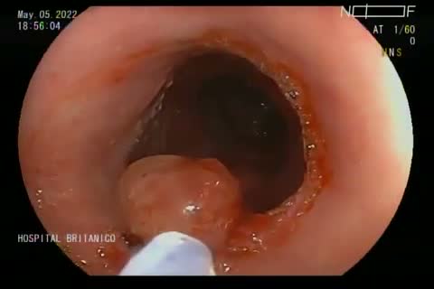 Band Mucosectomy (Duette Technique): An Excellent Option For The Treatment Of Early Neoplasia In Barrett’s Esophagus. By Dr Nicolas Gonzalez