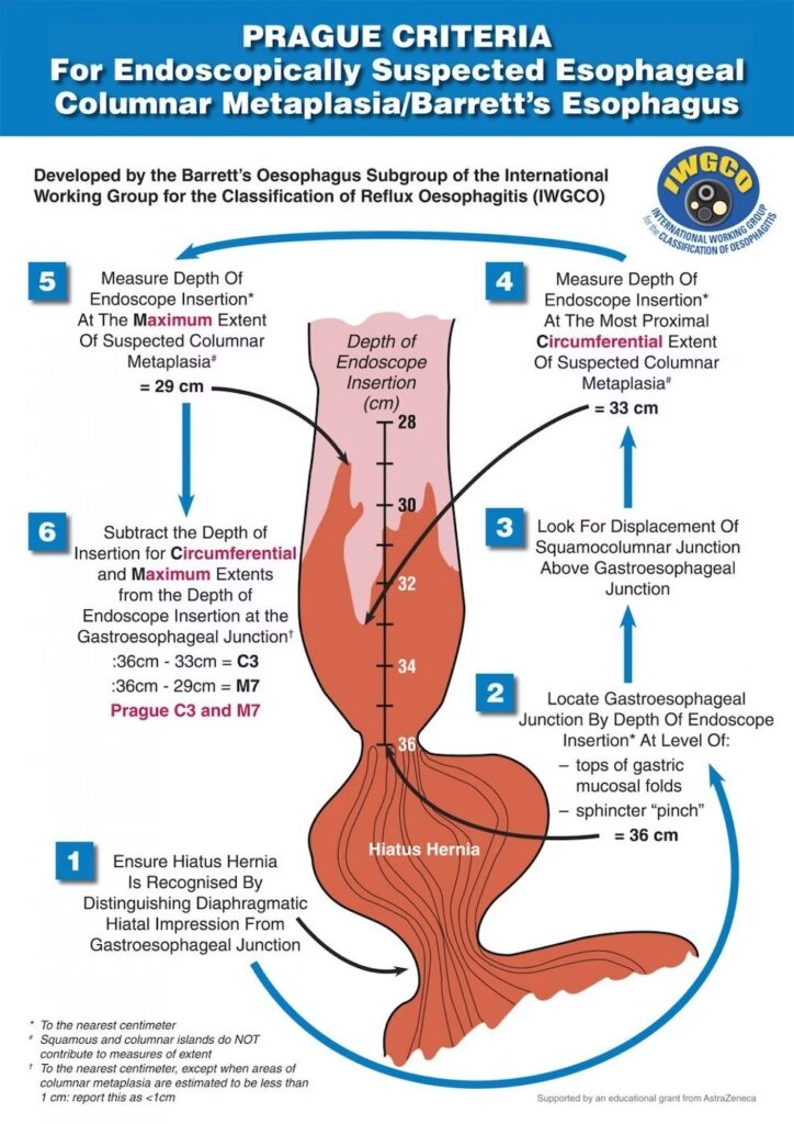 Barrett'S Esophagus - Prague (Or C&Amp;M) Classification 11 Barrett’s Esophagus – Prague (Or C&Amp;M) Classification