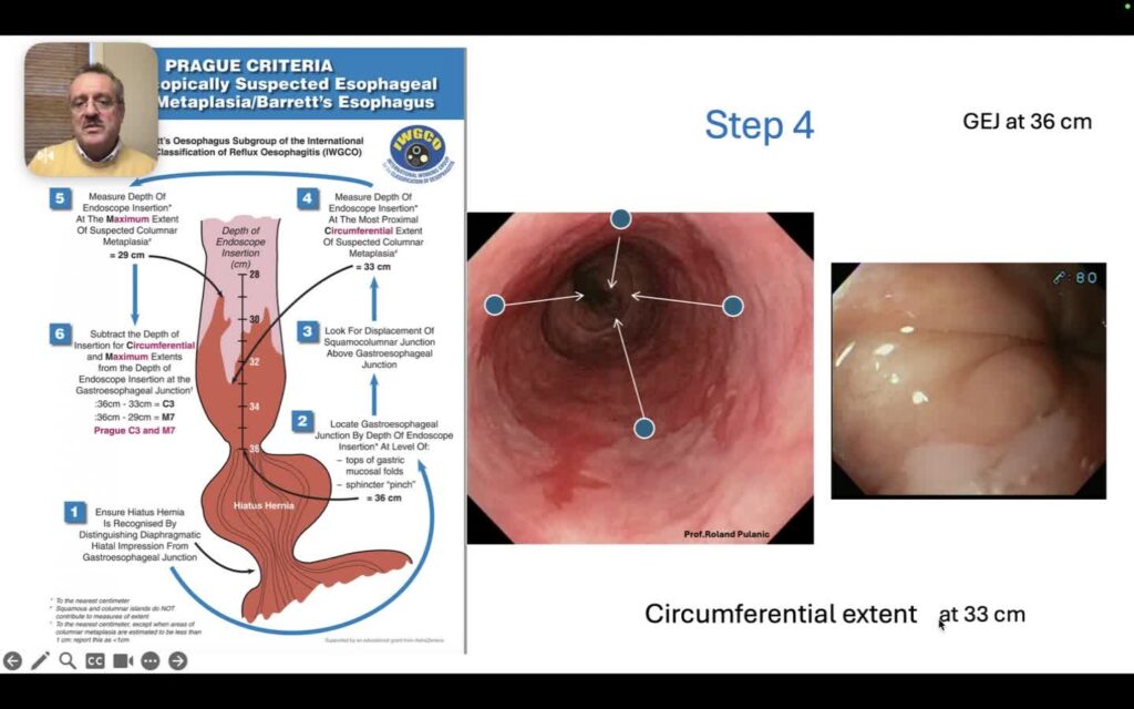 Barrett’s Esophagus – Prague Classification
