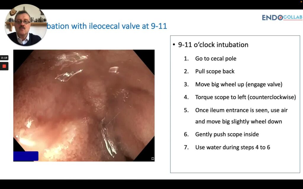Basic Endoscopy - Tips For Ileum Intubation (Quick Tips) 1 Basic Endoscopy – Tips For Ileum Intubation (Quick Tips)