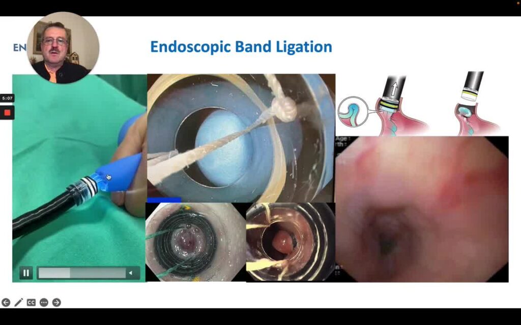 Basic Principles And Key Steps For Endoscopic Band Ligation Of Esophageal Varices 12 Basic Principles And Key Steps For Endoscopic Band Ligation Of Esophageal Varices