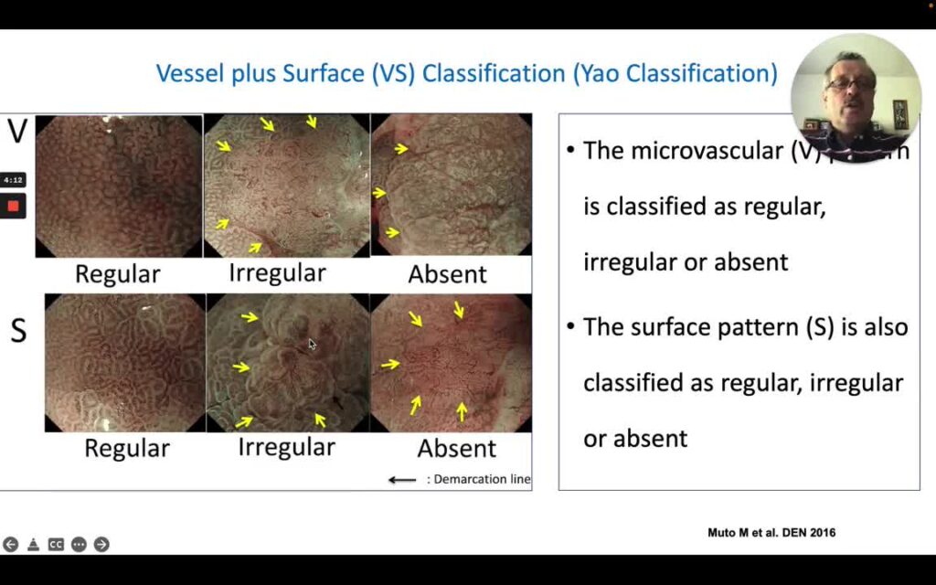 Basic Principles of Endoscopic Inspection โ Yao Classification