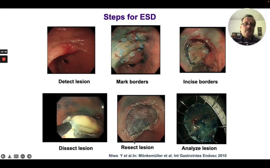 Basic Principles Of Endoscopic Resection For Early Gastric Cancer