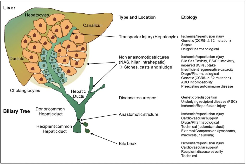 Bile Duct Injury After Liver Transplantation