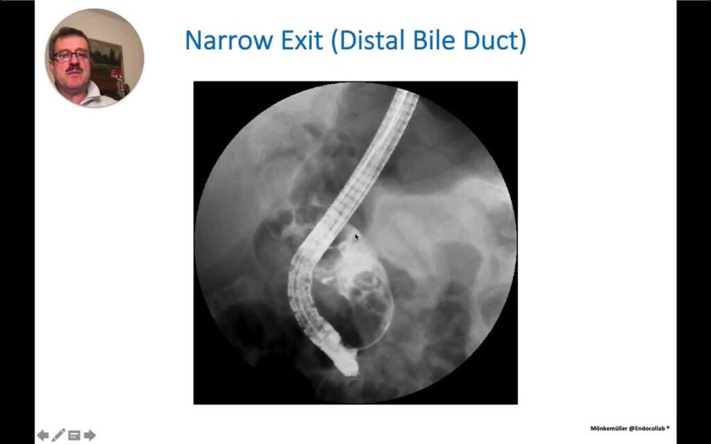 Bile Duct Stones – An Endoscopic And Cholangiographic Atlas – Lecture