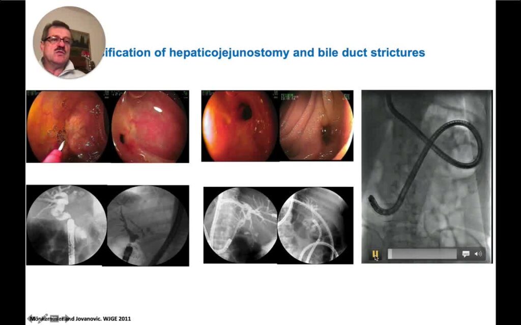 Bile Duct Stones - Surgically Deranged Post-Op Anatomy Of The Upper Gi Tract As Contributor To Difficulty 12 Bile Duct Stones – Surgically Deranged Post-Op Anatomy Of The Upper Gi Tract As Contributor To Difficulty