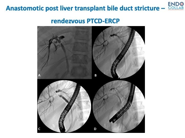 Bile Duct Strictures