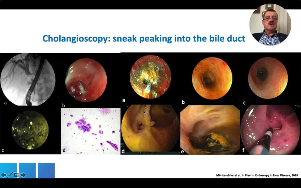 Bile Duct Strictures: A Practical Approach, Part 2