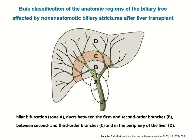Buis Classification Of The Anatomic Regions Of The Bile Ducts And Liver Affected By Non-Anastomotic Biliary Strictures