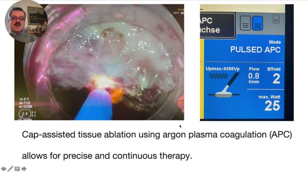 Cap-Assisted Argon Plasma Coagulation