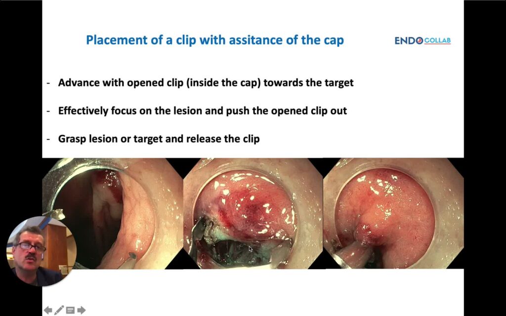 Cap-Assisted Clip Placement For Gi Bleeding