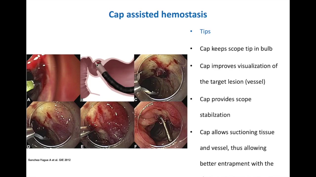 Cap-Assisted Hemostasis: Circular Cap, Load-And-Pull, Then Target 1 Slide Listing Cap-Assisted Hemostasis Tips: Keep The Tip In The Bulb, Improve Visualization, Stabilize The Scope, Suction Tissue Around The Vessel