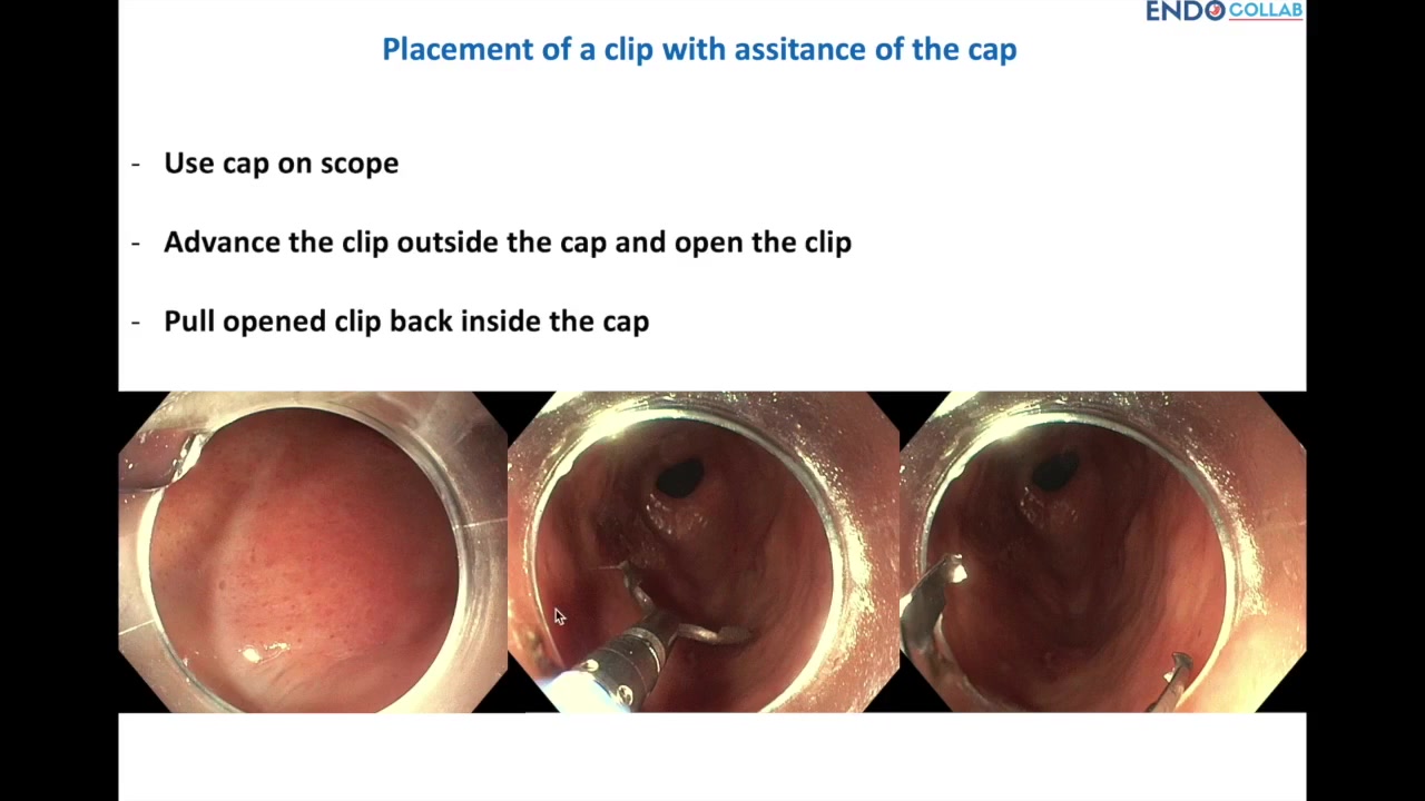 Cap-Assisted Hemostasis: Circular Cap, Load-And-Pull, Then Target 3 Three-Step Slide: Cap On The Scope, Clip Advanced And Opened Outside The Cap, Open Clip Pulled Back Inside The Cap