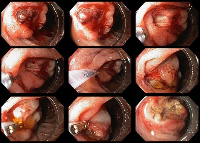 Cap-Assisted Hemostasis For Post-Sphincterotomy Bleeding