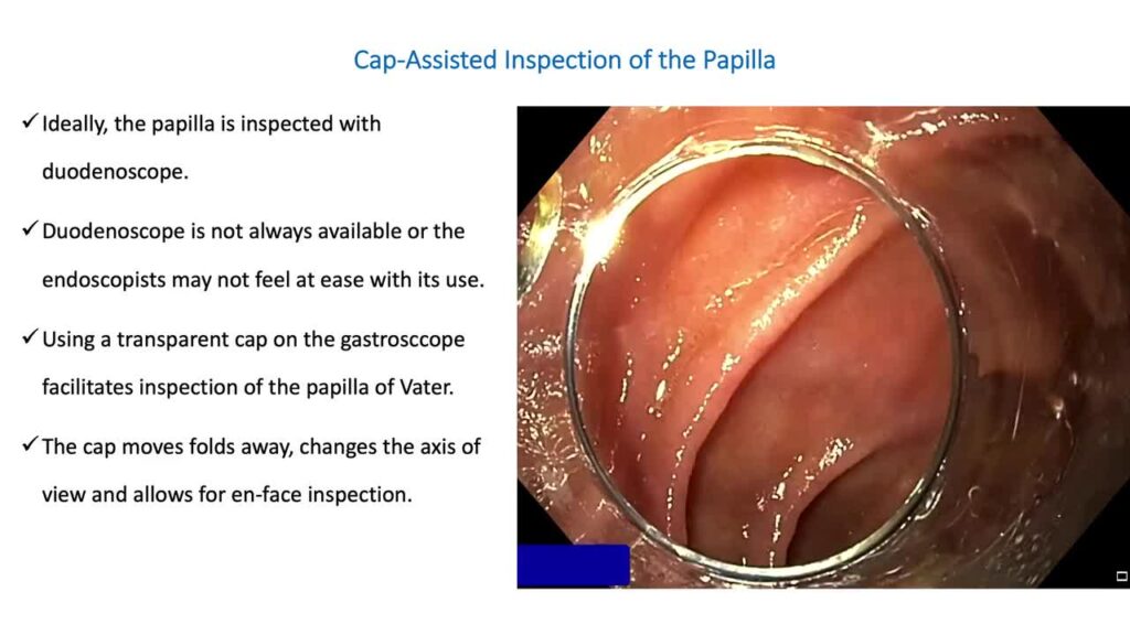 Cap-Assisted Papilla Inspection
