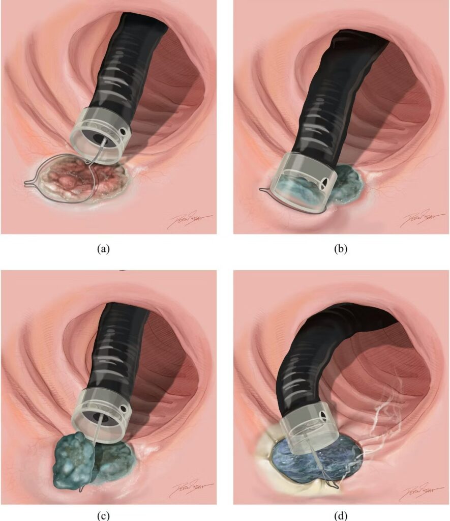 Cap-Assisted Piecemeal Emr For Non-Lifting Non-Polypoid Colon Lesions