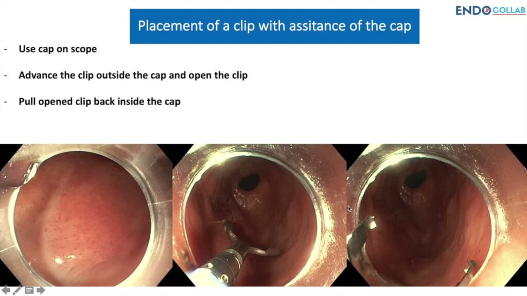 Cap Clip Assisted Hemostasis English 10 Cap Clip Assisted Hemostasis English