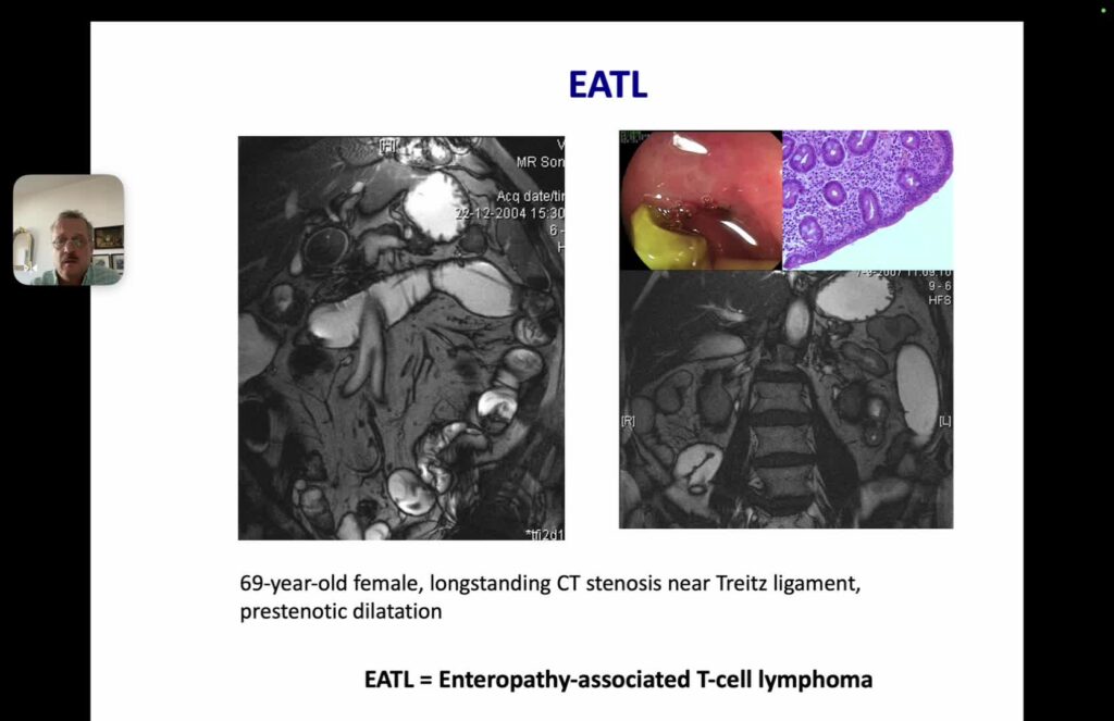 Capsula endoscopica y enteroscopia en enfermedad de Crohn