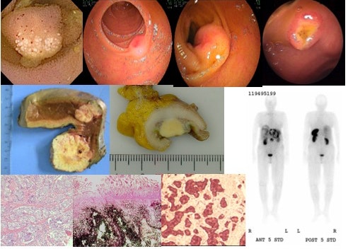 Carcinoid (Neuroendocrine Tumor, Net) Of The Jejunum