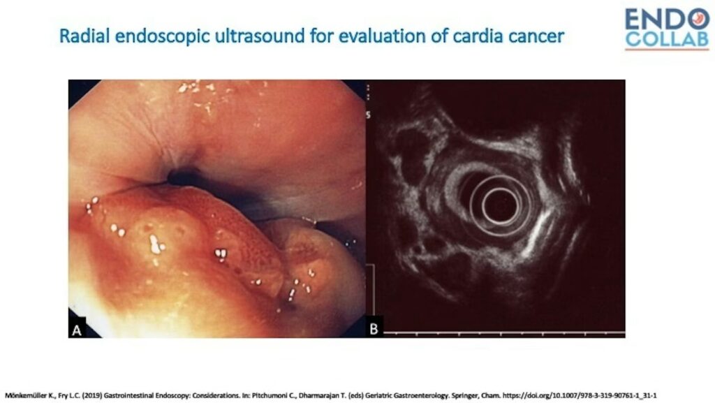 Cardia Cancer 9 Cardia Cancer
