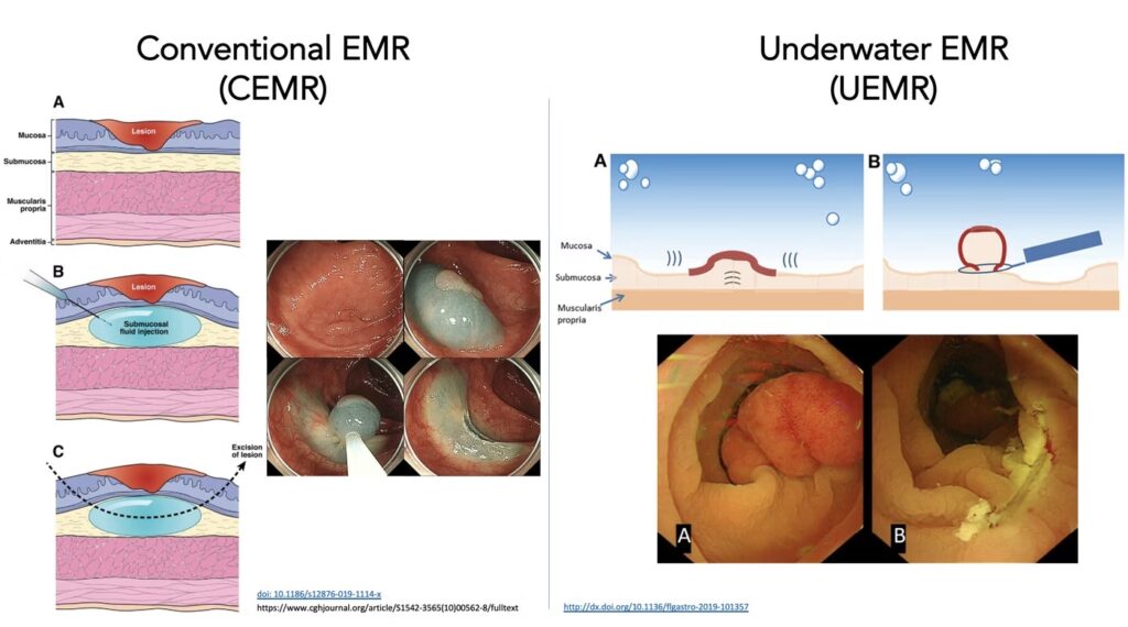 Cemr Vs. Uemr