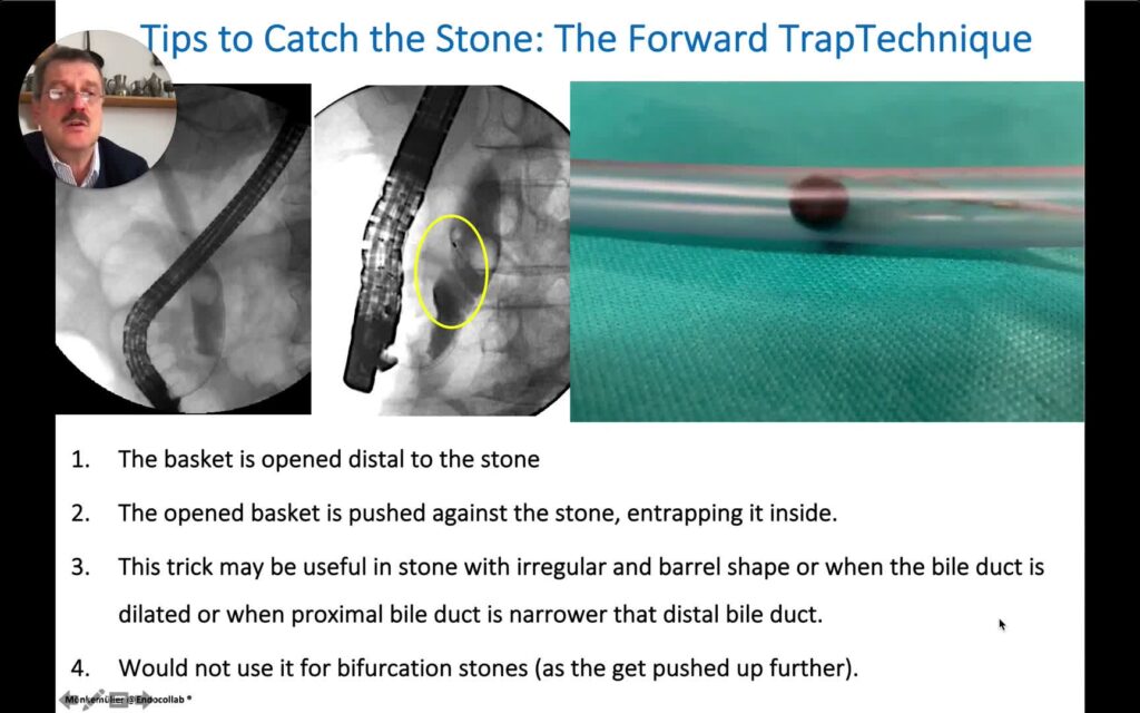 Challenges In Ercp: Management Of Bile Duct Stones (Part 2) – Using Stone Extraction Baskets