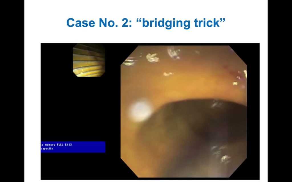 Challenging Biliary Cannulation (Part I)