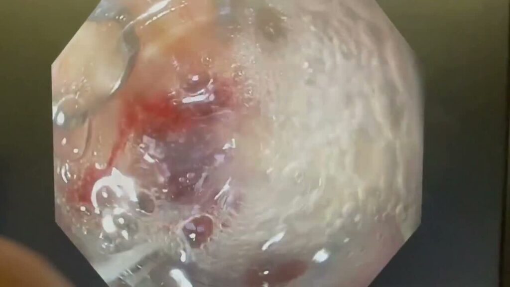 Challenging Distal Esophageal Ulcer With Large Visible Vessel Treated With Over-The-Scope-Clip (Otsc)