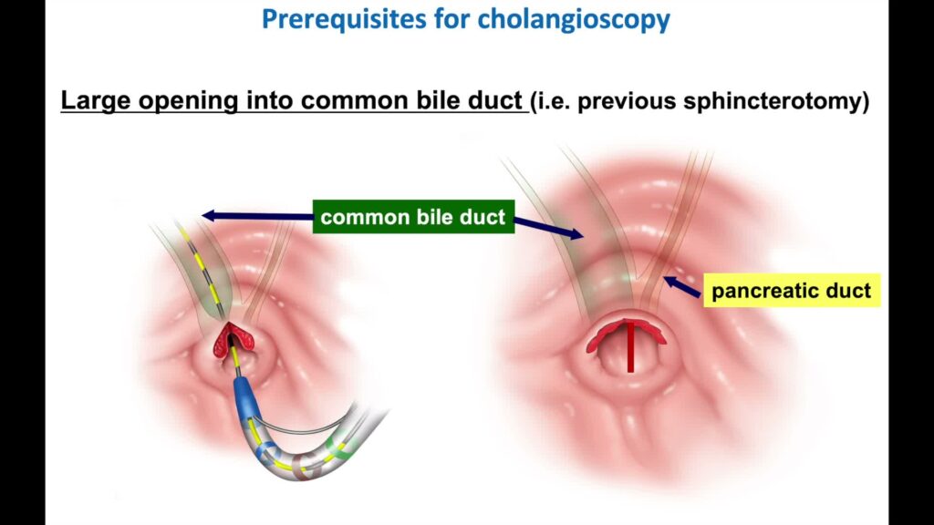 Cholangioscopy 5 Min Fridays June 4th