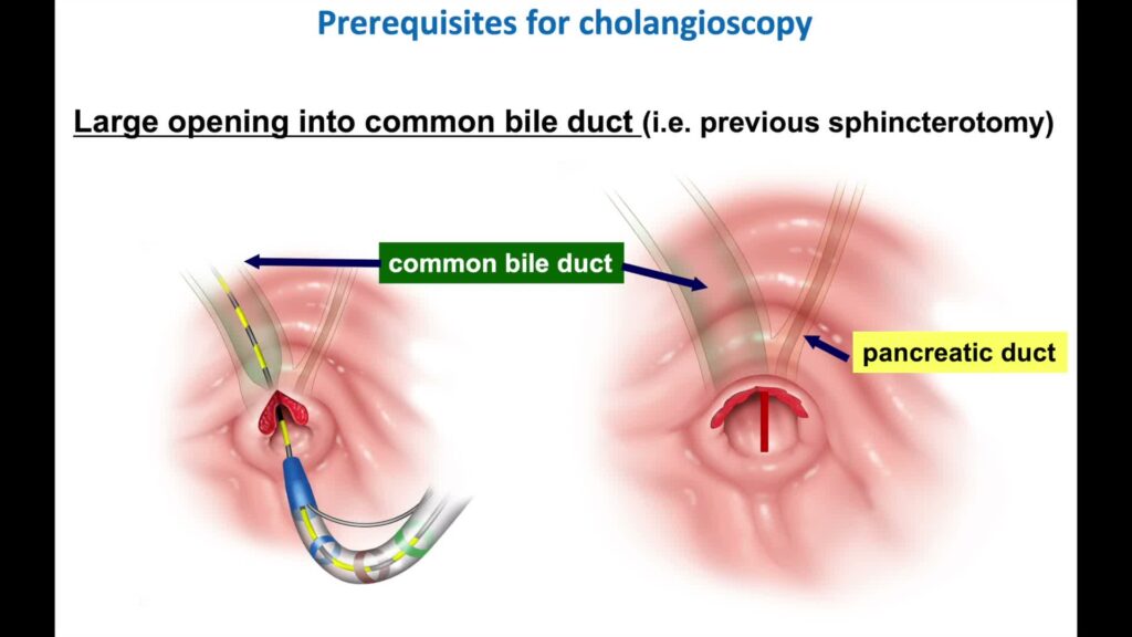 Cholangioscopy 3 Cholangioscopy