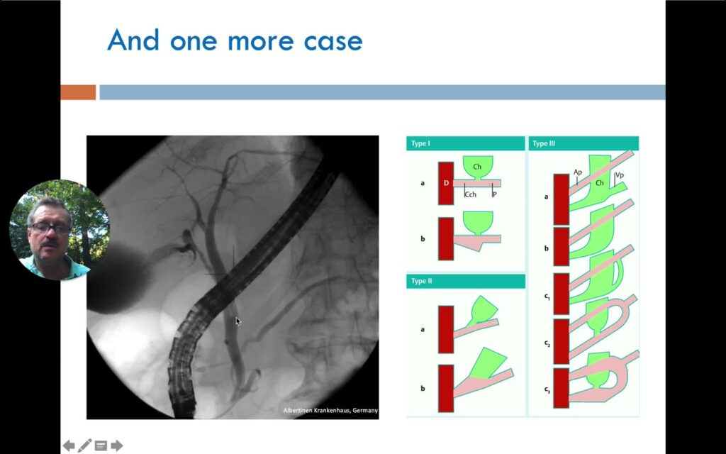Choledocal Cysts and Pancreatobiliary Maljunction