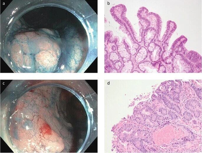 Chromoendoscopy And Histology Of Endoscopically Visible Lesions In Ulcerative Colitis. 21 Chromoendoscopy And Histology Of Endoscopically Visible Lesions In Ulcerative Colitis.