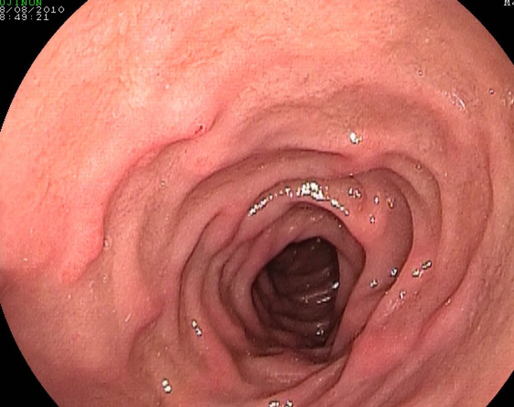 Churg Strauss Vasculitis (Allergic Or Eosinophilic Granulomatous Polyangitis – Agpa)