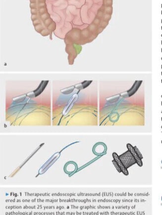 Classic Innovations In Endoscopy: Therapeutic Eus 9 Classic Innovations In Endoscopy: Therapeutic Eus