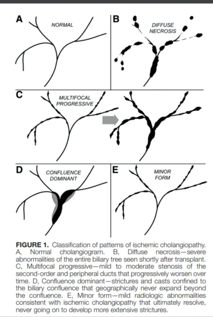 Classification Of Distinct Patterns Of Ischemic Cholangiopathy Following Donation-After-Circulatory-Death Liver Transplantation