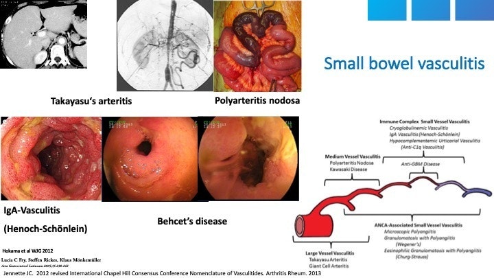 Classification Of Small Bowel Vasculitis 11 Classification Of Small Bowel Vasculitis