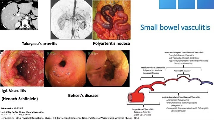 Classification Of Small Bowel Vasculitis
