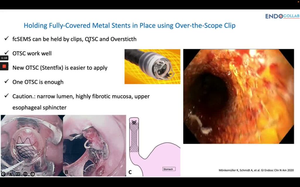 Clip OTSC para anclar Stents (fcSEMS)