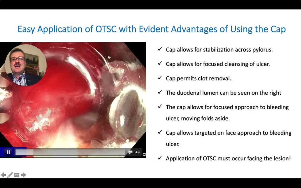 Clip Ovesco (Otsc) Para Hemostasia De Úlcera Sangrante Duodenal