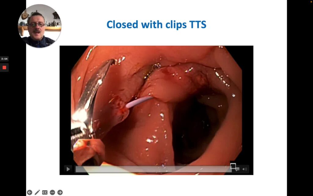 Closing a complex gastro-cool-cutaneous fistula using double scope technique and more