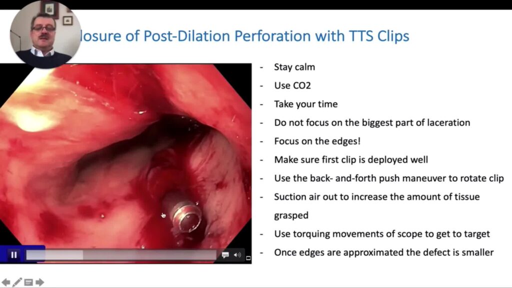 Closing A Perforation After Balloon Dilation With Tts (Through-The-Scope) Clips 10 Closing A Perforation After Balloon Dilation With Tts (Through-The-Scope) Clips