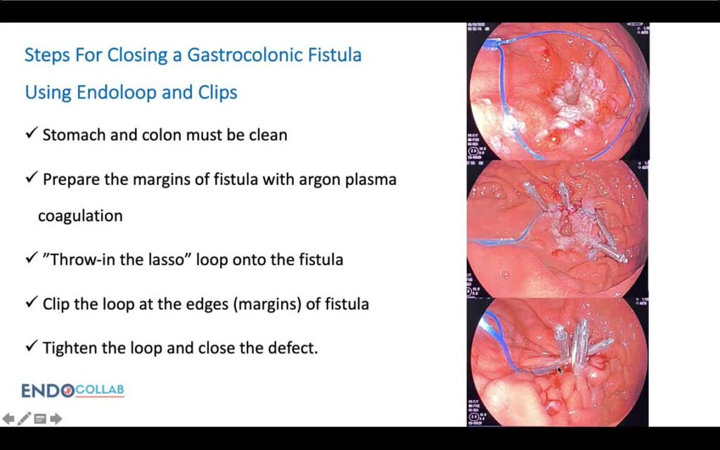 Closing Leaks, Perforations Or Fistula With The Loop-And Clips Technique (“Crown Method”)
