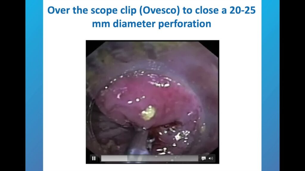 Closure of big GI defects April 3