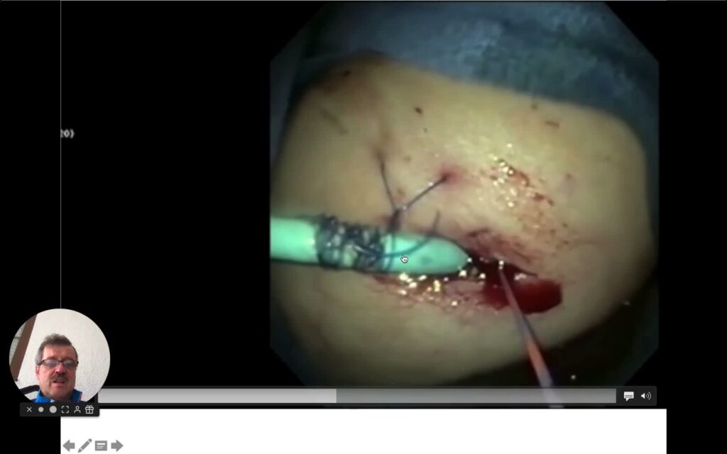 Closure Of Complex Surgical Iatrogenic Leak In Patient With Roux-En-Y Gastric Bypass (Part Ii Of Series On Endoscopy After Bariatric Surgery)