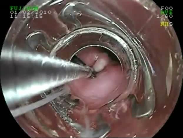 Closure Of Esophagotracheal Fistula Induced By Provox Voice Prothesis Using Over-The-Scope Clip (Otsc)