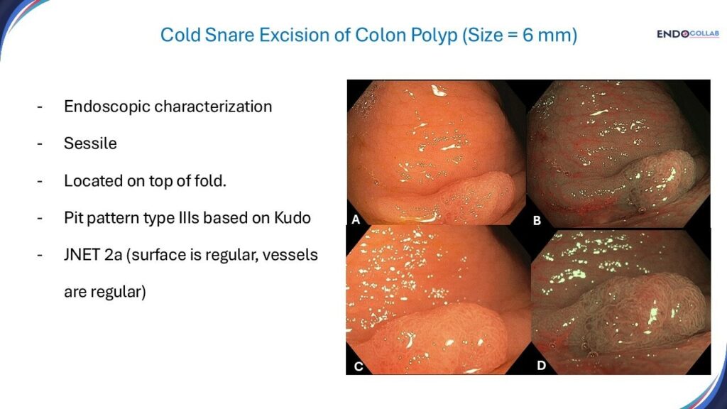 Cold Snare Excision Of Small Sessile Polyp