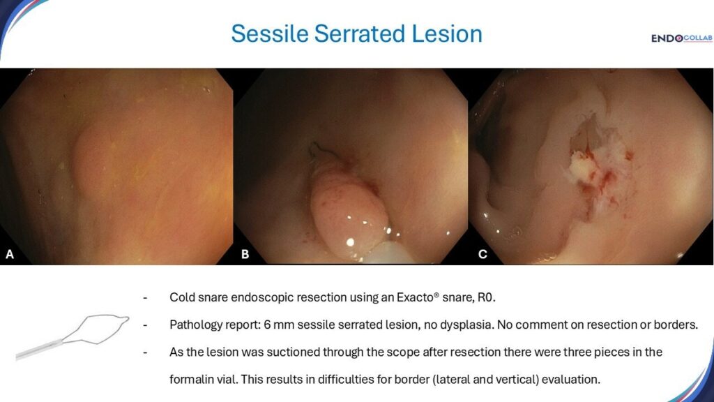 Cold Snare Resection For Sessile Serrated Lesion &Lt; 10 Mm