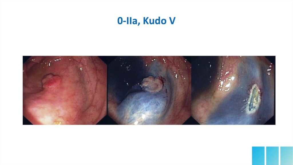 Colon Polyp Characterization