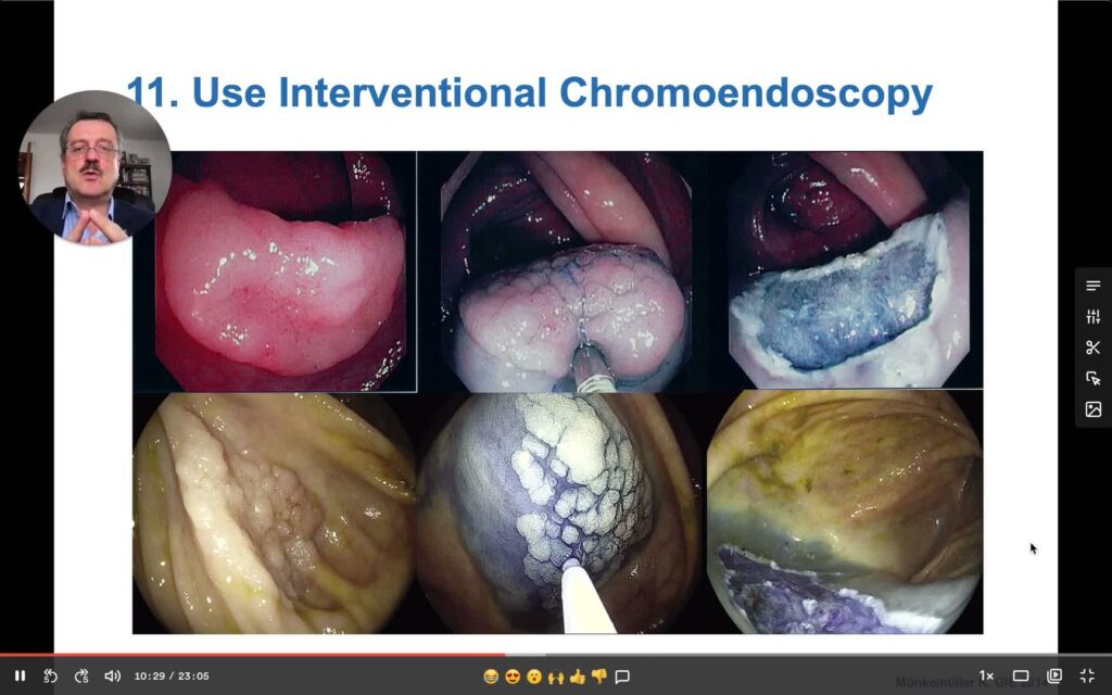 Colon Polypectomy – Esd: Fundamental Principles